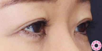 年代：50代 施術名：二重埋没法 施術後｜【公式】東京形成美容外科