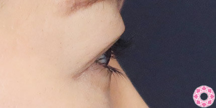 年代：50代 施術名：二重埋没法 施術後｜【公式】東京形成美容外科