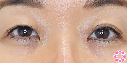 年代：50代 施術名：二重埋没法 施術前｜【公式】東京形成美容外科