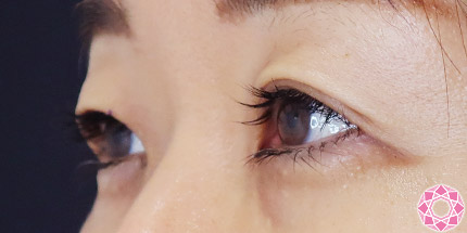 年代：50代 施術名：二重埋没法 施術前｜【公式】東京形成美容外科