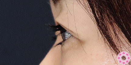 年代：50代 施術名：二重埋没法 施術前｜【公式】東京形成美容外科