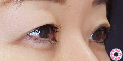 年代：50代 施術名：二重埋没法 施術前｜【公式】東京形成美容外科