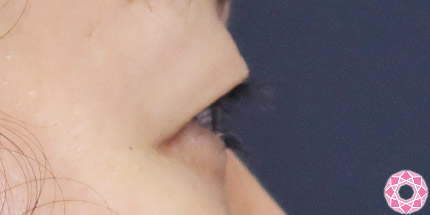 年代：50代 施術名：二重埋没法 施術前｜【公式】東京形成美容外科