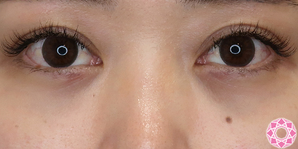 年代：30代 施術名：目の下のふくらみ取り 施術後｜【公式】東京形成美容外科