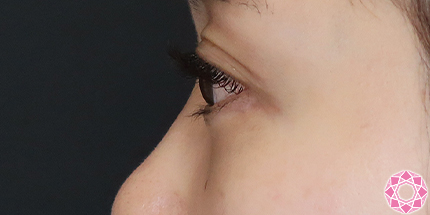 年代：30代 施術名：目の下のふくらみ取り 施術後｜【公式】東京形成美容外科