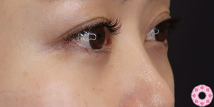 年代：30代 施術名：目の下のふくらみ取り 施術後｜【公式】東京形成美容外科