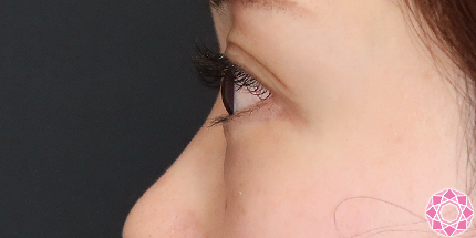 年代：30代 施術名：目の下のふくらみ取り 施術前｜【公式】東京形成美容外科