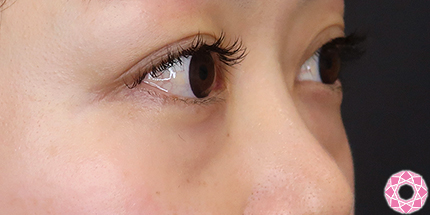 年代：30代 施術名：目の下のふくらみ取り 施術前｜【公式】東京形成美容外科