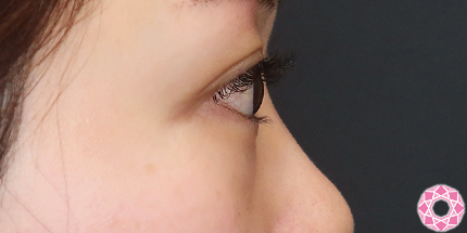 年代：30代 施術名：目の下のふくらみ取り 施術前｜【公式】東京形成美容外科