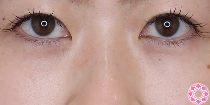 年代：30代 施術名：目の下のふくらみ取り 施術後｜【公式】東京形成美容外科