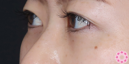 年代：30代 施術名：目の下のふくらみ取り 施術後｜【公式】東京形成美容外科