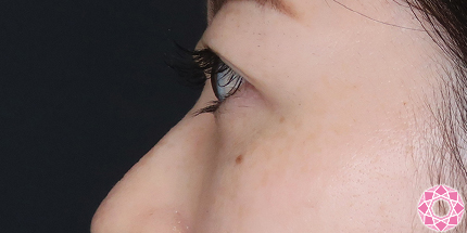 年代：30代 施術名：目の下のふくらみ取り 施術後｜【公式】東京形成美容外科