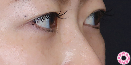 年代：30代 施術名：目の下のふくらみ取り 施術後｜【公式】東京形成美容外科