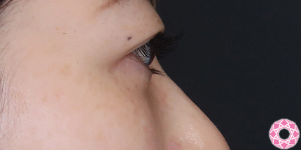 年代：30代 施術名：目の下のふくらみ取り 施術後｜【公式】東京形成美容外科