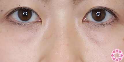 年代：30代 施術名：目の下のふくらみ取り 施術前｜【公式】東京形成美容外科