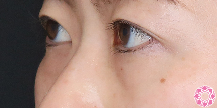 年代：30代 施術名：目の下のふくらみ取り 施術前｜【公式】東京形成美容外科