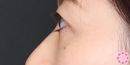 年代：30代 施術名：目の下のふくらみ取り 施術前｜【公式】東京形成美容外科