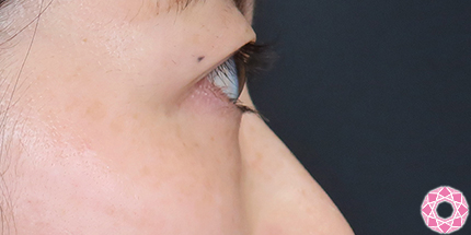 年代：30代 施術名：目の下のふくらみ取り 施術前｜【公式】東京形成美容外科