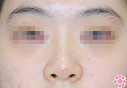 年代：20代 施術名：プチ隆鼻術（ヒアルロン酸） 施術後｜【公式】東京形成美容外科