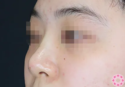 年代：20代 施術名：プチ隆鼻術（ヒアルロン酸） 施術後｜【公式】東京形成美容外科