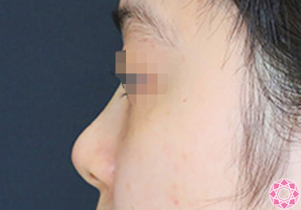 年代：20代 施術名：プチ隆鼻術（ヒアルロン酸） 施術後｜【公式】東京形成美容外科