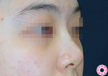 年代：20代 施術名：プチ隆鼻術（ヒアルロン酸） 施術後｜【公式】東京形成美容外科