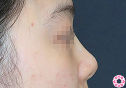 年代：20代 施術名：プチ隆鼻術（ヒアルロン酸） 施術後｜【公式】東京形成美容外科