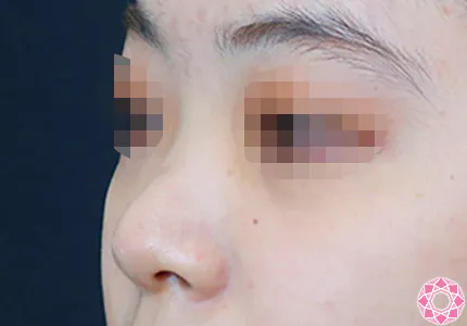 年代：20代 施術名：プチ隆鼻術（ヒアルロン酸） 施術前｜【公式】東京形成美容外科