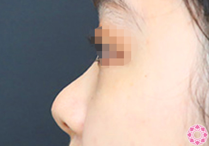 年代：20代 施術名：プチ隆鼻術（ヒアルロン酸） 施術前｜【公式】東京形成美容外科