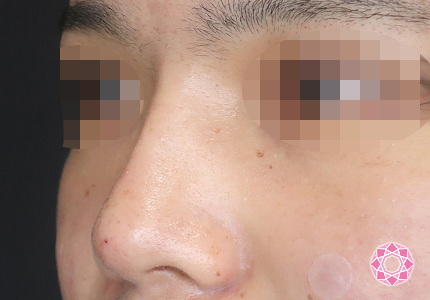 年代：20代 施術名：ジュビダーム 施術後｜【公式】東京形成美容外科