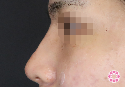 年代：20代 施術名：ジュビダーム 施術後｜【公式】東京形成美容外科