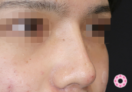 年代：20代 施術名：ジュビダーム 施術後｜【公式】東京形成美容外科