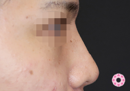 年代：20代 施術名：ジュビダーム 施術後｜【公式】東京形成美容外科