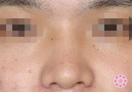 年代：20代 施術名：ジュビダーム 施術前｜【公式】東京形成美容外科