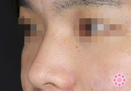 年代：20代 施術名：ジュビダーム 施術前｜【公式】東京形成美容外科