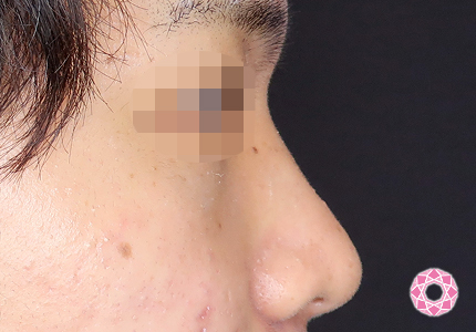 年代：20代 施術名：ジュビダーム 施術前｜【公式】東京形成美容外科