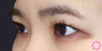 年代：30代 施術名：二重埋没法 施術後｜【公式】東京形成美容外科