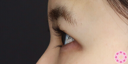 年代：30代 施術名：二重埋没法 施術後｜【公式】東京形成美容外科