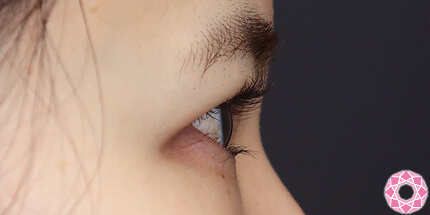 年代：30代 施術名：二重埋没法 施術後｜【公式】東京形成美容外科