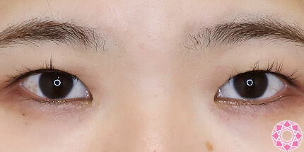 年代：30代 施術名：二重埋没法 施術前｜【公式】東京形成美容外科