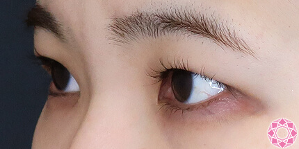 年代：30代 施術名：二重埋没法 施術前｜【公式】東京形成美容外科