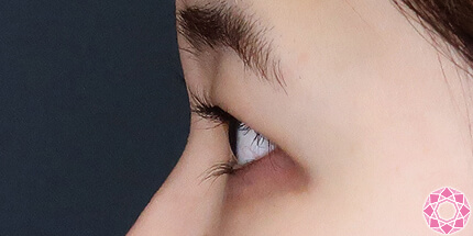 年代：30代 施術名：二重埋没法 施術前｜【公式】東京形成美容外科