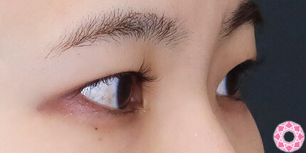 年代：30代 施術名：二重埋没法 施術前｜【公式】東京形成美容外科