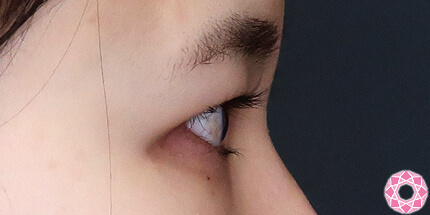 年代：30代 施術名：二重埋没法 施術前｜【公式】東京形成美容外科