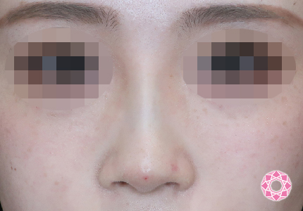 年代：20代 施術名：ジュビダーム 施術後｜【公式】東京形成美容外科