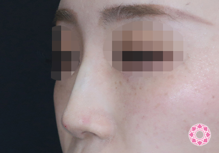 年代：20代 施術名：ジュビダーム 施術後｜【公式】東京形成美容外科