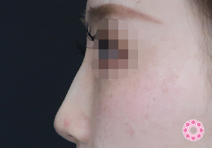 年代：20代 施術名：ジュビダーム 施術後｜【公式】東京形成美容外科