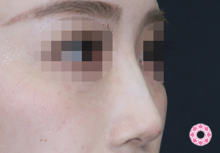 年代：20代 施術名：ジュビダーム 施術後｜【公式】東京形成美容外科