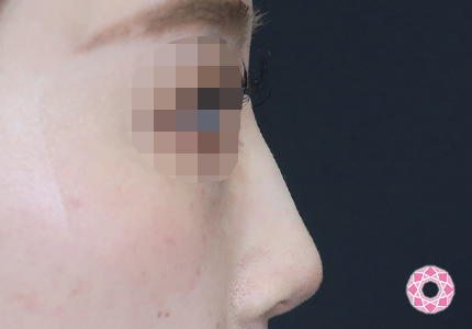 年代：20代 施術名：ジュビダーム 施術後｜【公式】東京形成美容外科