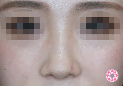 年代：20代 施術名：ジュビダーム 施術前｜【公式】東京形成美容外科